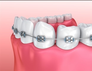 5 Reasons to Consider Traditional Braces l Richardson Orthodontics